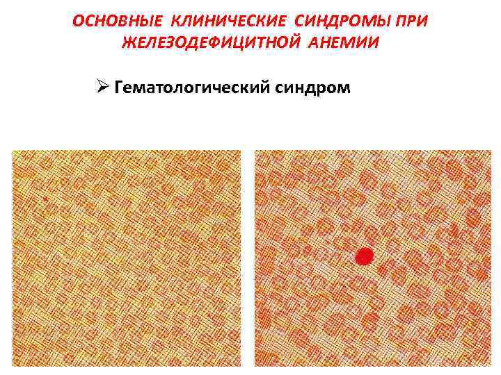 Метилурацил при анемии схема