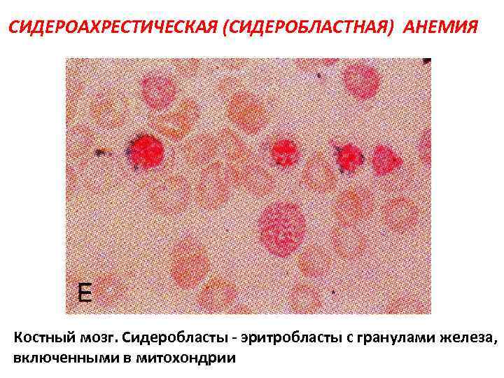 СИДЕРОАХРЕСТИЧЕСКАЯ (СИДЕРОБЛАСТНАЯ) АНЕМИЯ Костный мозг. Сидеробласты - эритробласты с гранулами железа, включенными в митохондрии