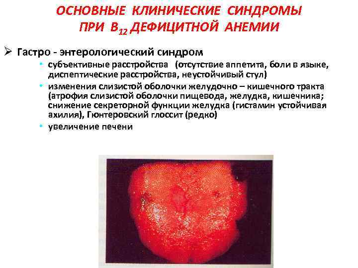 ОСНОВНЫЕ КЛИНИЧЕСКИЕ СИНДРОМЫ ПРИ В 12 ДЕФИЦИТНОЙ АНЕМИИ Ø Гастро - энтерологический синдром •