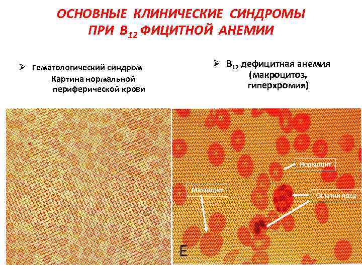 ОСНОВНЫЕ КЛИНИЧЕСКИЕ СИНДРОМЫ ПРИ В 12 ФИЦИТНОЙ АНЕМИИ Ø Гематологический синдром Картина нормальной периферической