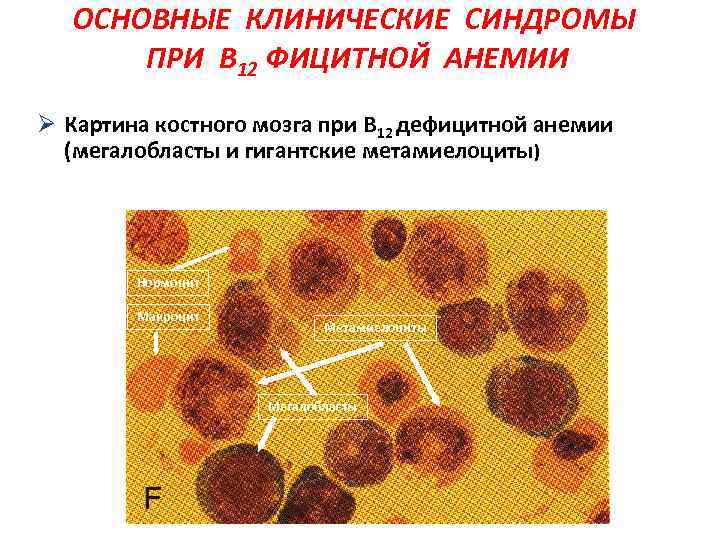 ОСНОВНЫЕ КЛИНИЧЕСКИЕ СИНДРОМЫ ПРИ В 12 ФИЦИТНОЙ АНЕМИИ Ø Картина костного мозга при В