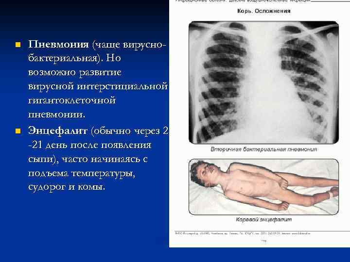 n n Пневмония (чаще вируснобактериальная). Но возможно развитие вирусной интерстициальной гигантоклеточной пневмонии. Энцефалит (обычно