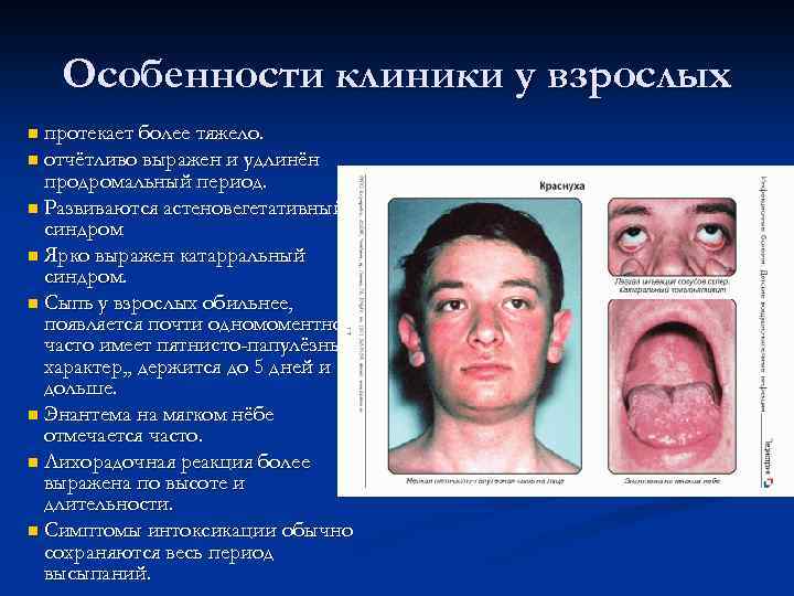 Особенности клиники у взрослых n протекает более тяжело. n отчётливо выражен и удлинён продромальный
