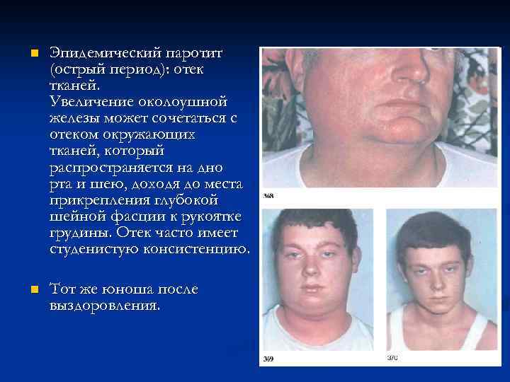 n Эпидемический паротит (острый период): отек тканей. Увеличение околоушной железы может сочетаться с отеком