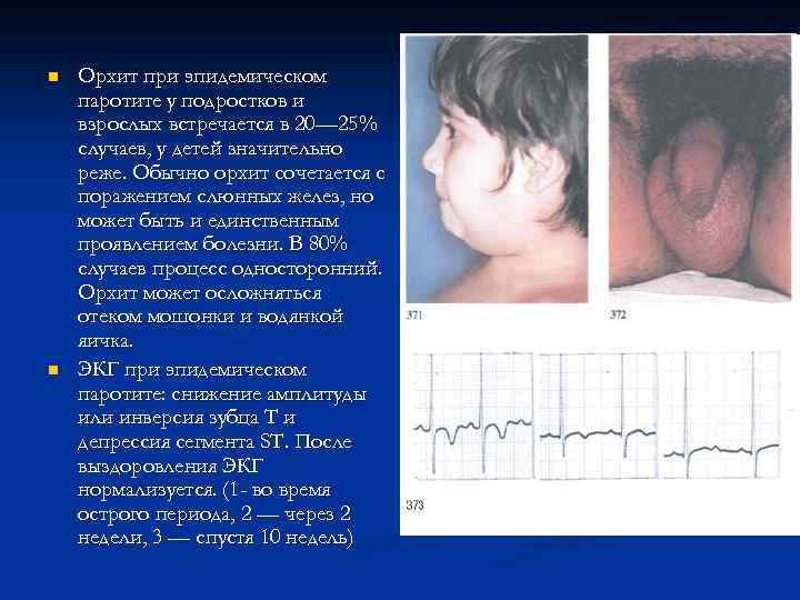 n n Орхит при эпидемическом паротите у подростков и взрослых встречается в 20— 25%