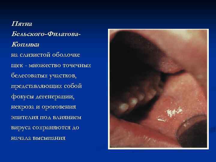 Пятна Бельского-Филатова. Коплика : на слизистой оболочке щек - множество точечных белесоватых участков, представляющих