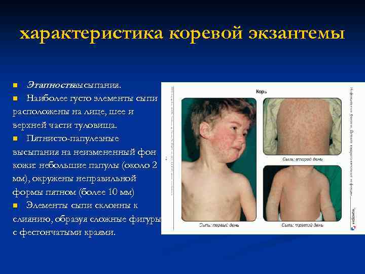 характеристика коревой экзантемы n Этапностьвысыпания. Наиболее густо элементы сыпи расположены на лице, шее и