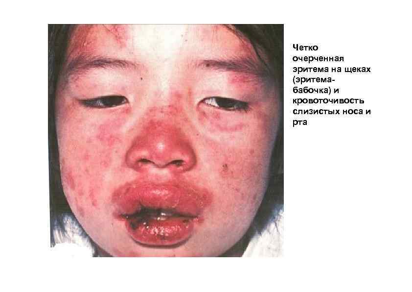 Четко очерченная эритема на щеках (эритемабабочка) и кровоточивость слизистых носа и рта 