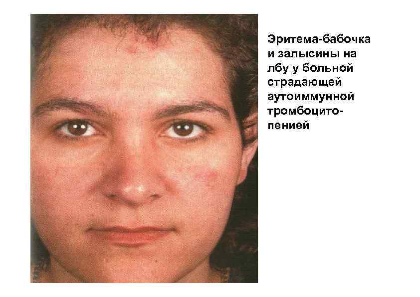 Эритема-бабочка и залысины на лбу у больной страдающей аутоиммунной тромбоцитопенией 