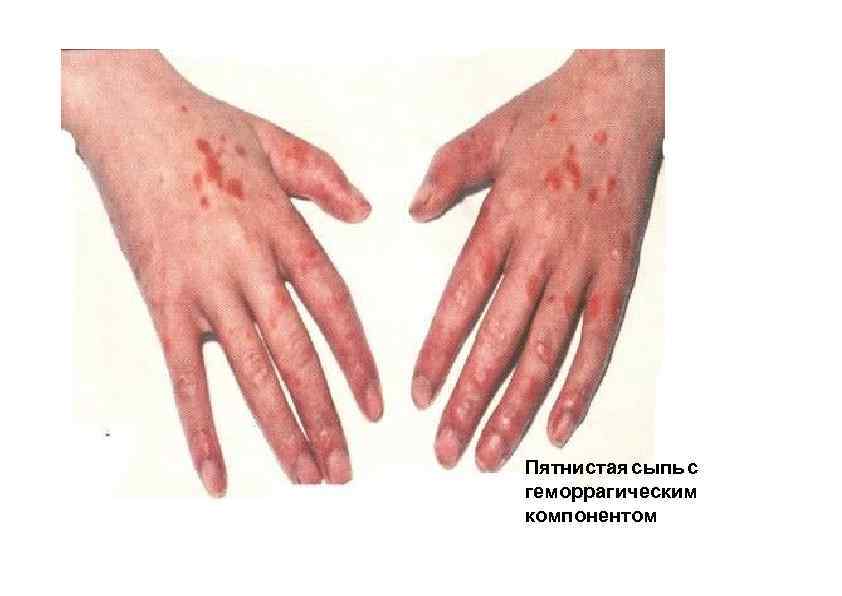 Пятнистая сыпь с геморрагическим компонентом 