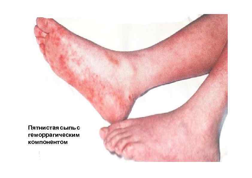 Пятнистая сыпь с геморрагическим компонентом 