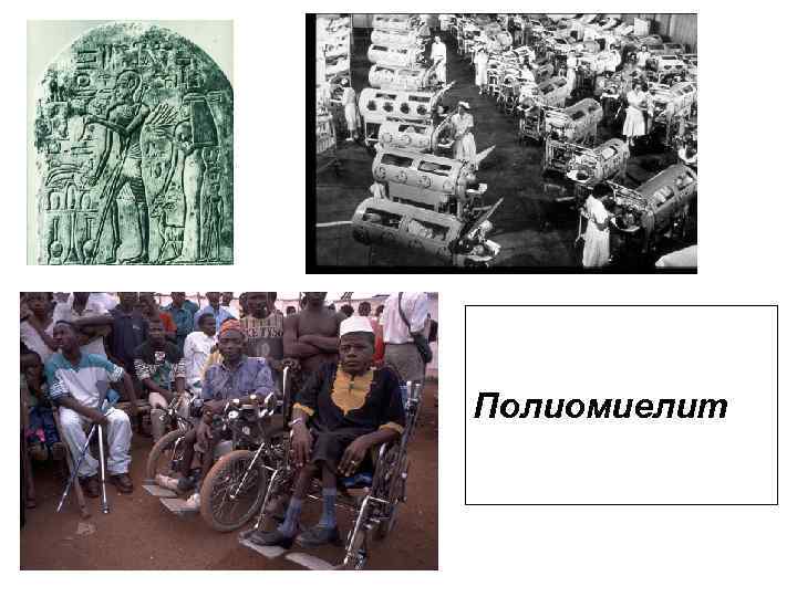 Полиомиелит 