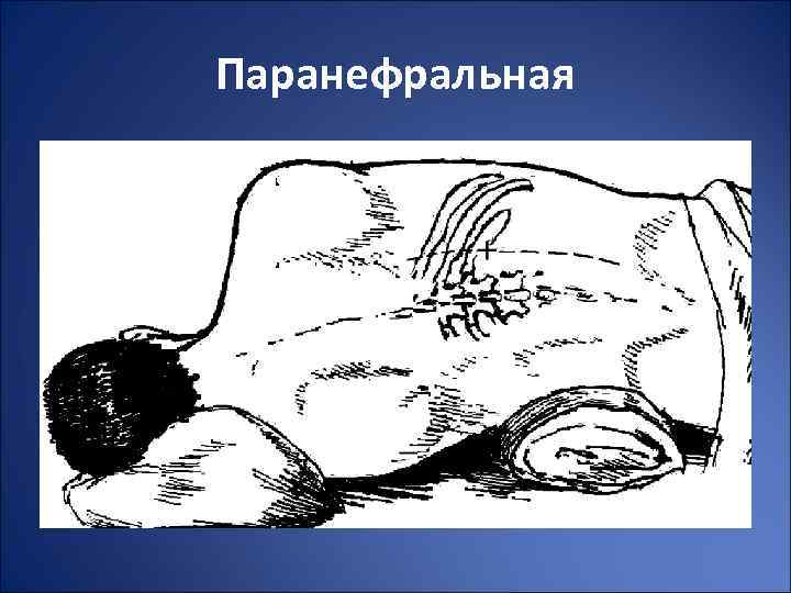 Паранефральная 