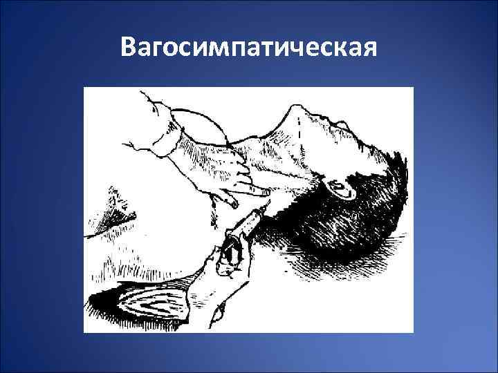 Вагосимпатическая 