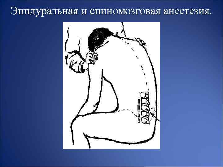 Эпидуральная и спиномозговая анестезия. 