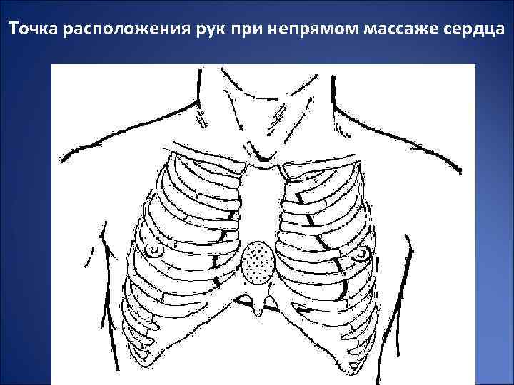 Точка расположения рук при непрямом массаже сердца 