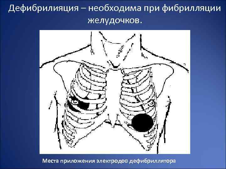 Дефибрилияция – необходима при фибрилляции желудочков. Места приложения электродов дефибриллятора 