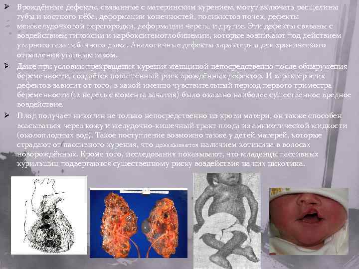Ø Врождённые дефекты, связанные с материнским курением, могут включать расщелины губы и костного нёба,