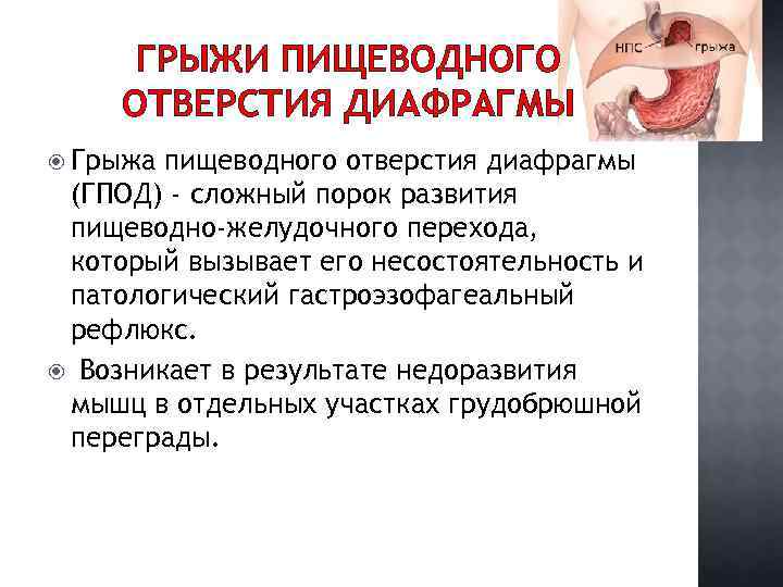 ГРЫЖИ ПИЩЕВОДНОГО ОТВЕРСТИЯ ДИАФРАГМЫ Грыжа пищеводного отверстия диафрагмы (ГПОД) - сложный порок развития пищеводно-желудочного