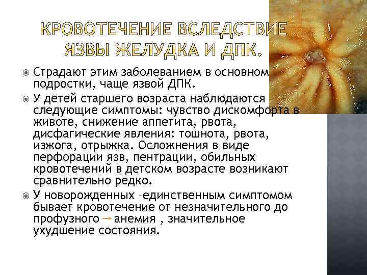 Страдают этим заболеванием в основном подростки, чаще язвой ДПК. У детей старшего возраста наблюдаются