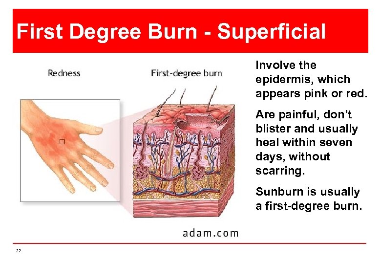 First Degree Burn - Superficial Involve the epidermis, which appears pink or red. Are