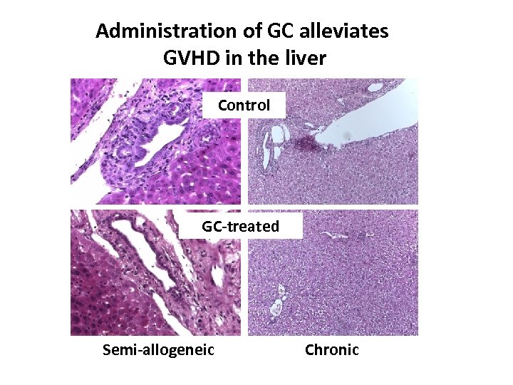 Administration of GC alleviates GVHD in the liver Control GC-treated Semi-allogeneic Chronic 