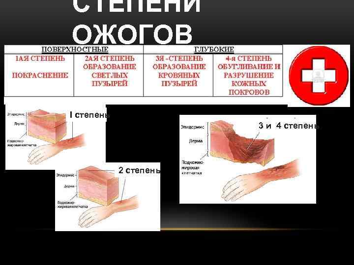 СТЕПЕНИ ОЖОГОВ I степень 3 и 4 степень 2 степень 