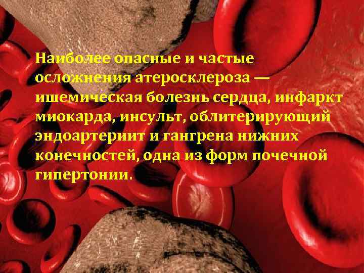 Наиболее опасные и частые осложнения атеросклероза — ишемическая болезнь сердца, инфаркт миокарда, инсульт, облитерирующий