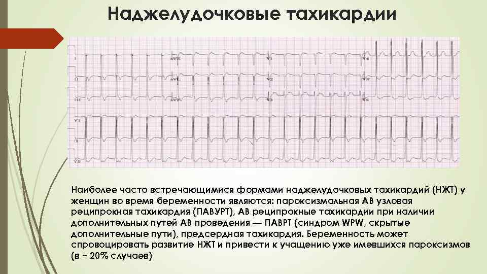 Наджелудочковая тахикардия презентация