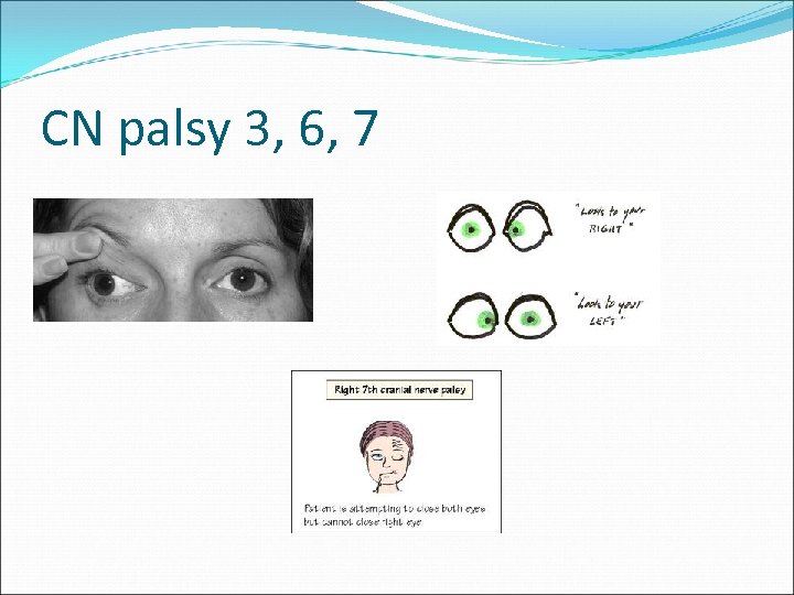 CN palsy 3, 6, 7 