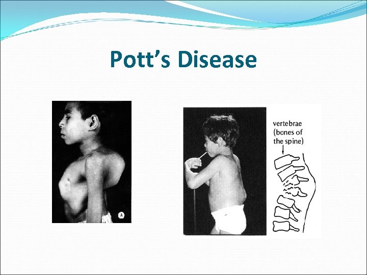Pott’s Disease 
