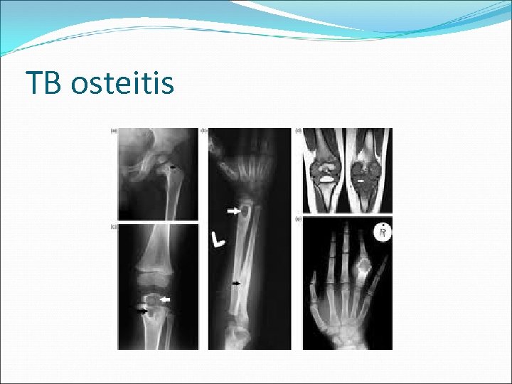 TB osteitis 