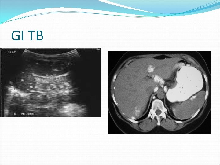 GI TB 