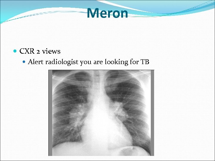 Meron CXR 2 views Alert radiologist you are looking for TB 