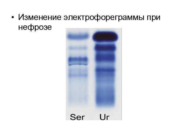  • Изменение электрофореграммы при нефрозе 