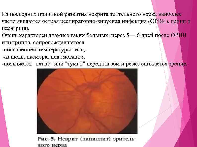 Из последних причиной развития неврита зрительного нерва наиболее часто являются острая респираторно-вирусная инфекция (ОРВИ),