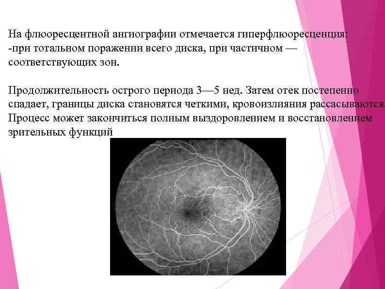 На флюоресцентной ангиографии отмечается гиперфлюоресценция: -при тотальном поражении всего диска, при частичном — соответствующих