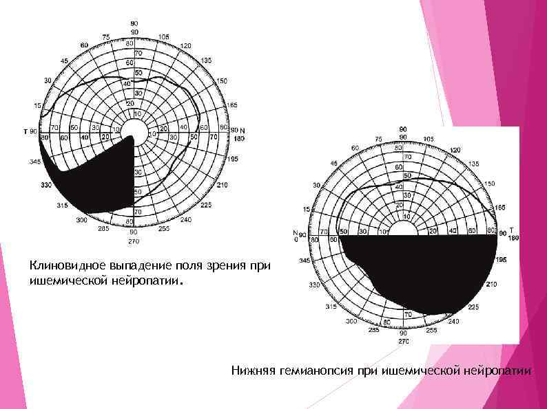 Клиновидное выпадение поля зрения при ишемической нейропатии. Нижняя гемианопсия при ишемической нейропатии 
