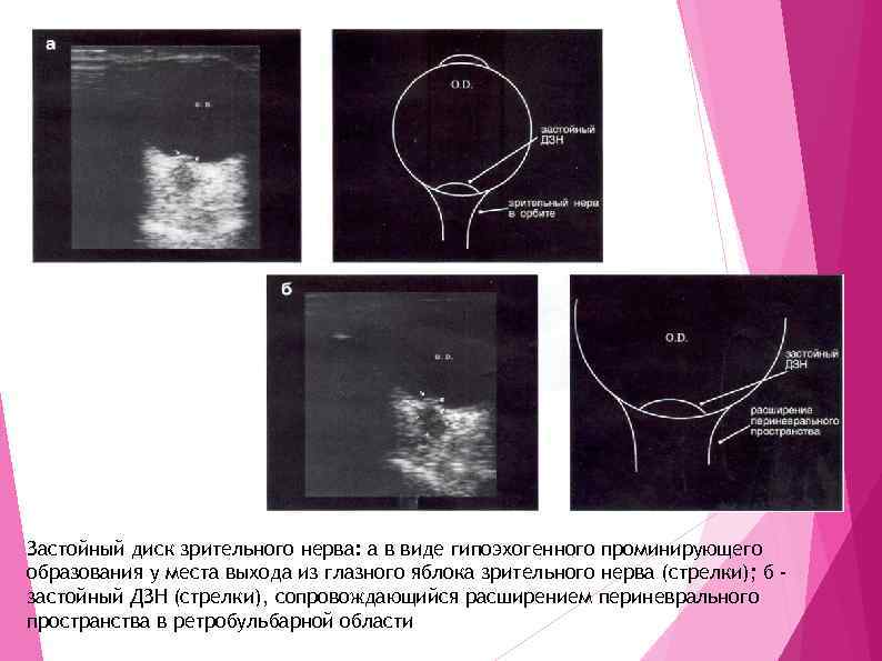 Застойный диск зрительного нерва: а в виде гипоэхогенного проминирующего образования у места выхода из