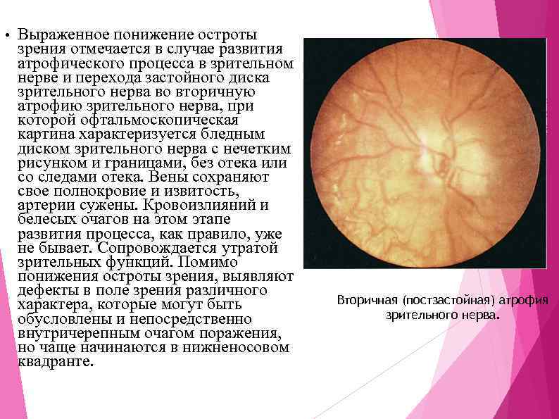  • Выраженное понижение остроты зрения отмечается в случае развития атрофического процесса в зрительном