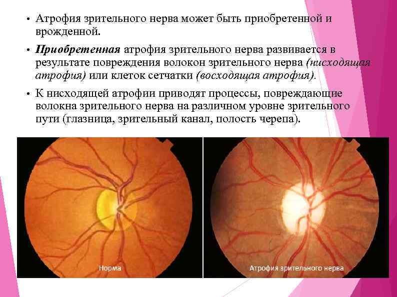 Атрофия зрительного нерва может быть приобретенной и врожденной. • Приобретенная атрофия зрительного нерва развивается