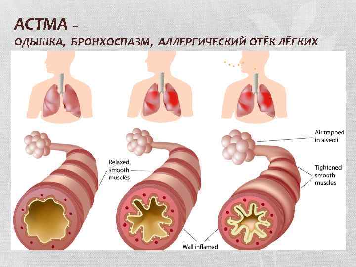 АСТМА – ОДЫШКА, БРОНХОСПАЗМ, АЛЛЕРГИЧЕСКИЙ ОТЁК ЛЁГКИХ 