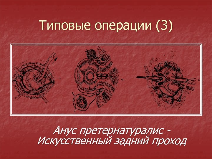 Типовые операции (3) Анус претернатуралис Искусственный задний проход 