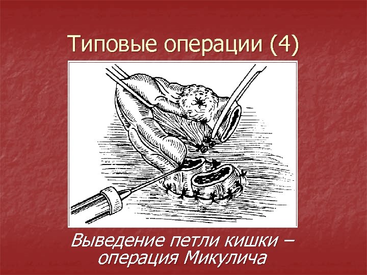 Типовые операции (4) Выведение петли кишки – операция Микулича 