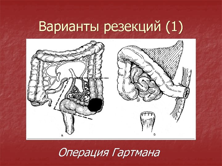 Варианты резекций (1) Операция Гартмана 