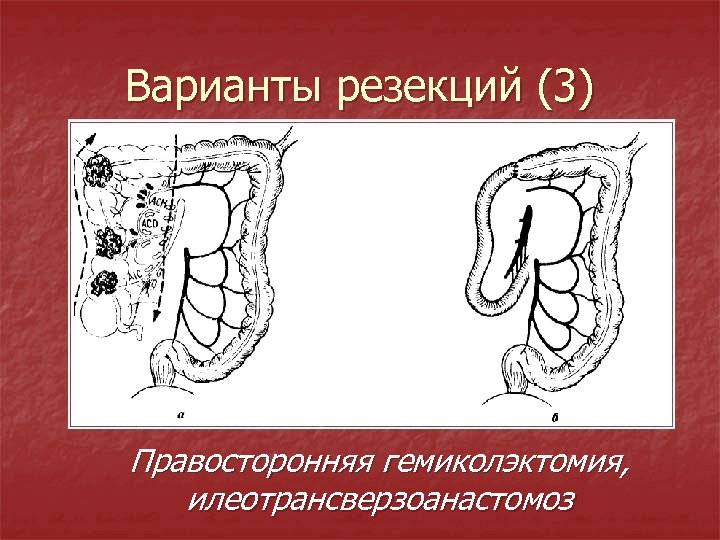 Варианты резекций (3) Правосторонняя гемиколэктомия, илеотрансверзоанастомоз 