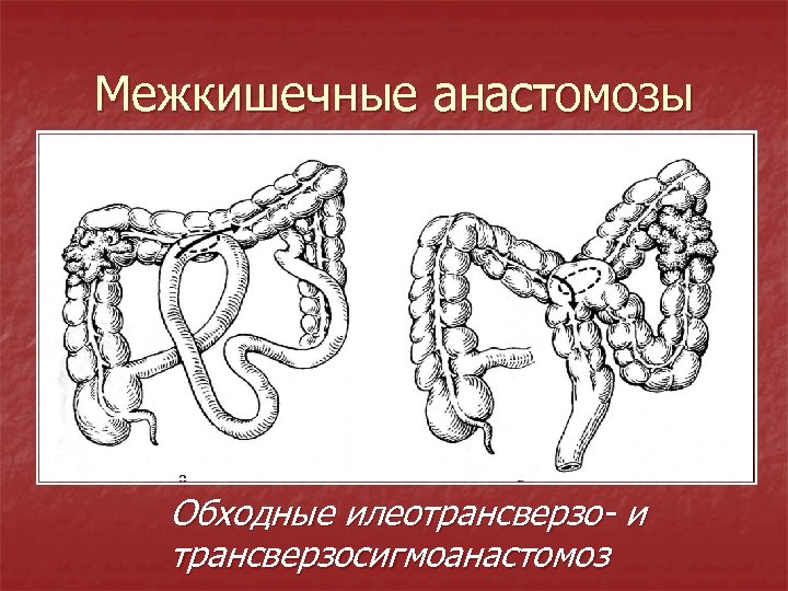 Межкишечные анастомозы Обходные илеотрансверзо- и трансверзосигмоанастомоз 