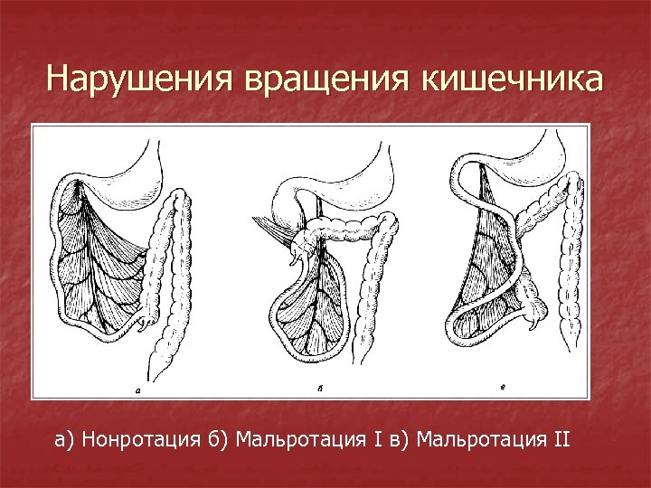 Нарушения вращения кишечника а) Нонротация б) Мальротация I в) Мальротация II 