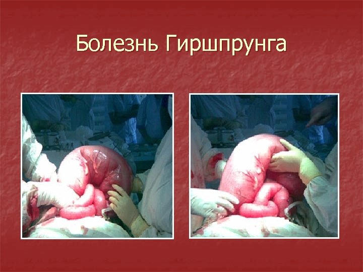 Болезнь Гиршпрунга 