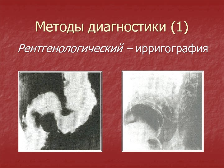 Методы диагностики (1) Рентгенологический – ирригография 